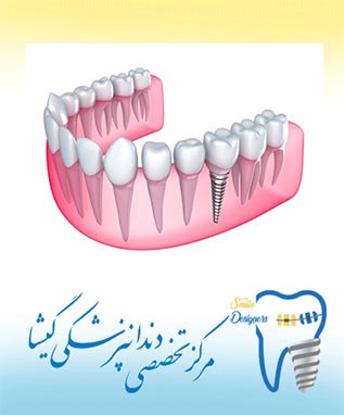 بهترین شرایط برای کاشت دندان ( ایمپلنت) توسط بهترین متخصص ایمپلنت در شمال تهران