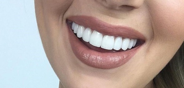 کامپوزیت دندان توسط دندانپزشک متخصص زیبایی در تهران
