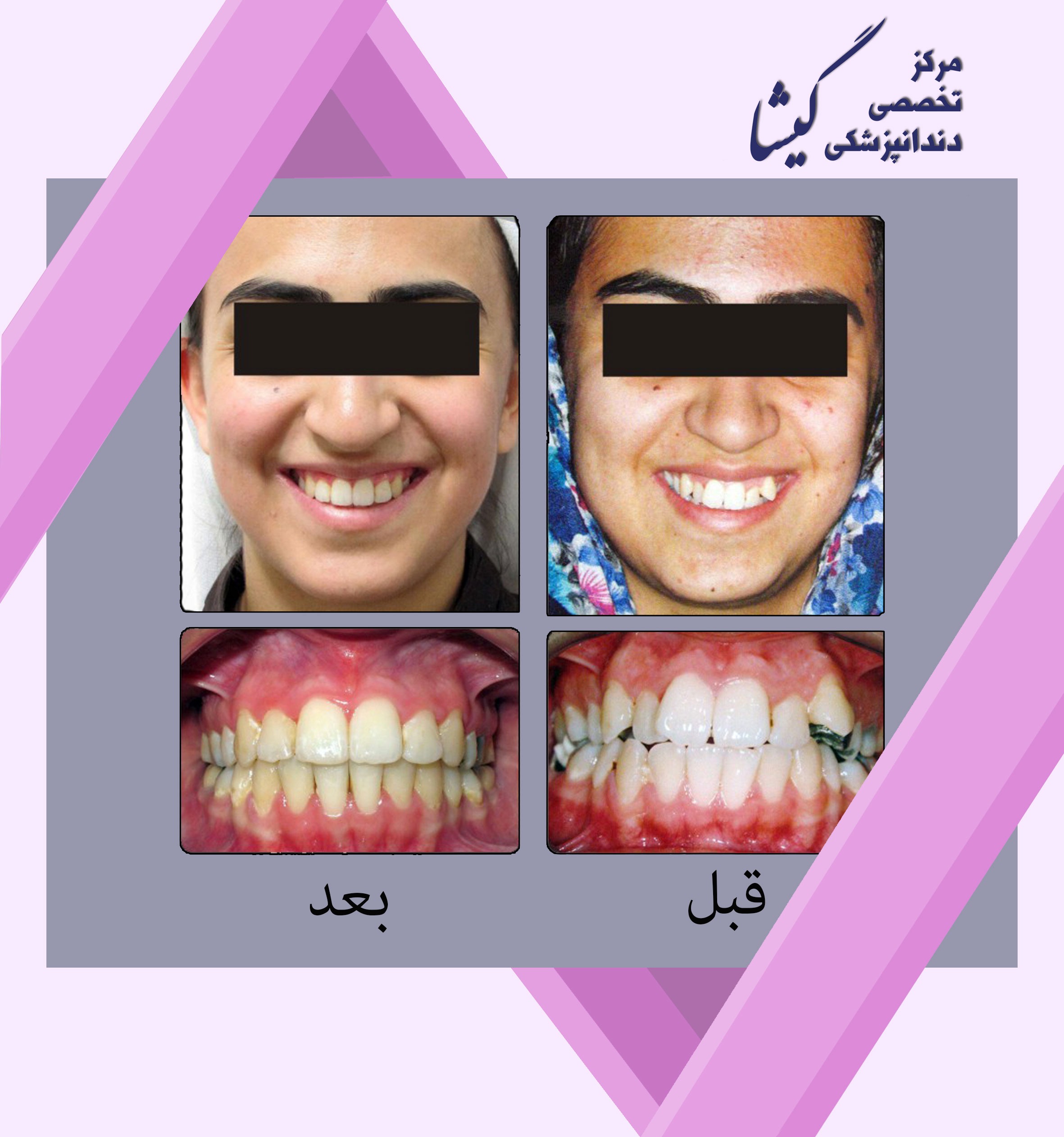 درمان ارتودنسي بيمار با بيرون زدگي دندان نيش و نامرتبي دندانها .
