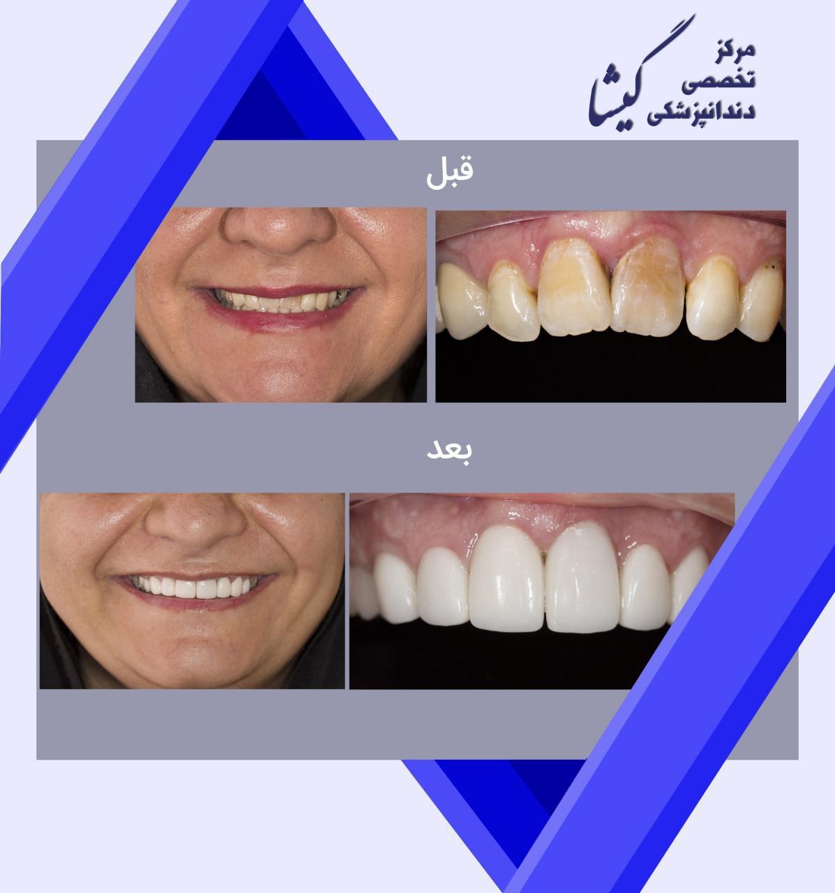 لامینیت سرامیکی ۸ دندان جلویی فک بالا توسط متخصص پروتز های دندانی و زیبایی در تهران