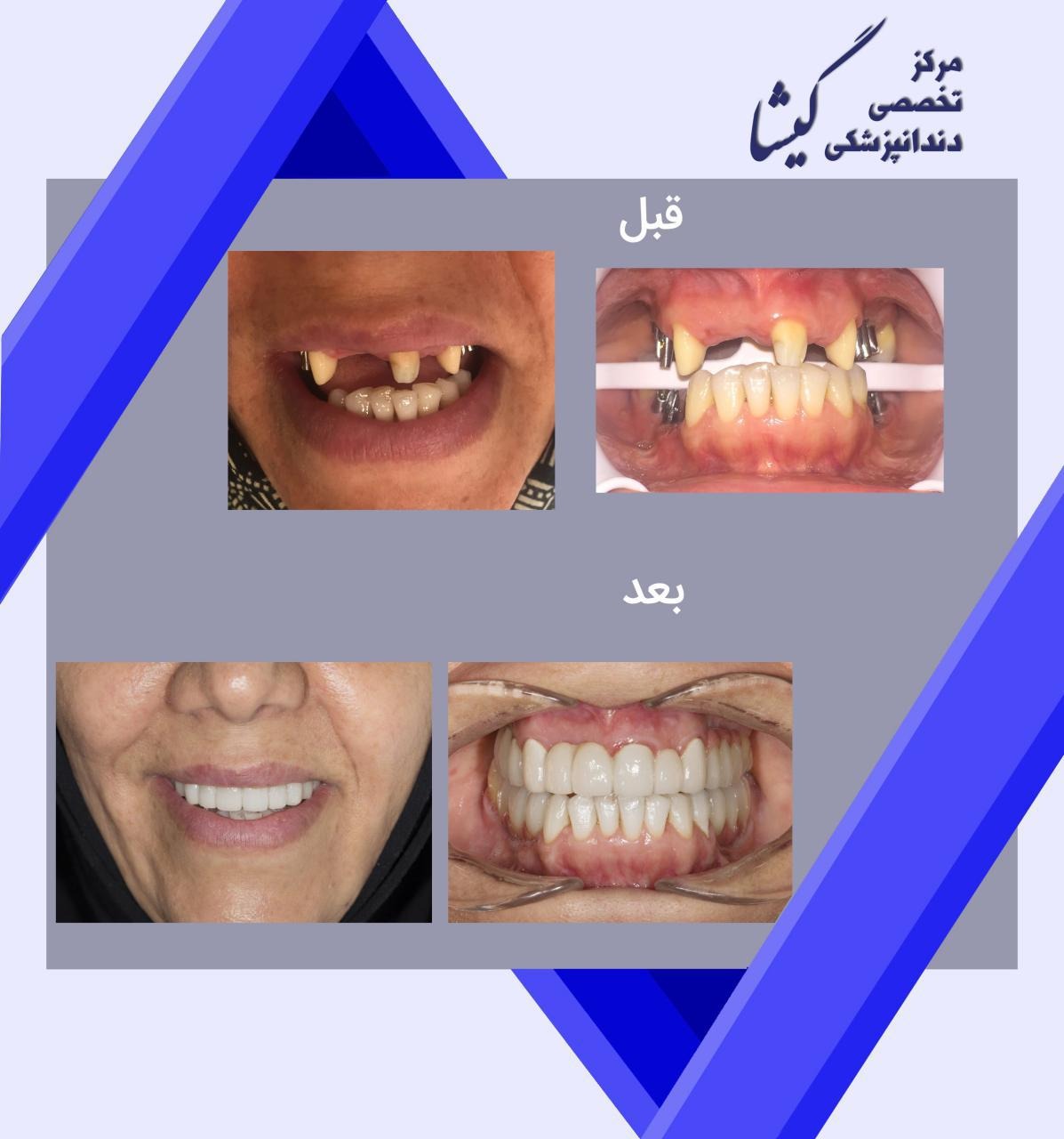 بازسازی دندانهای بیمار عزیزمان با ایمپلنت و روکش توسط دکتر عزیز گشاده رو (متخصص ایمپلنت و پروتزهای دندانی در تهران