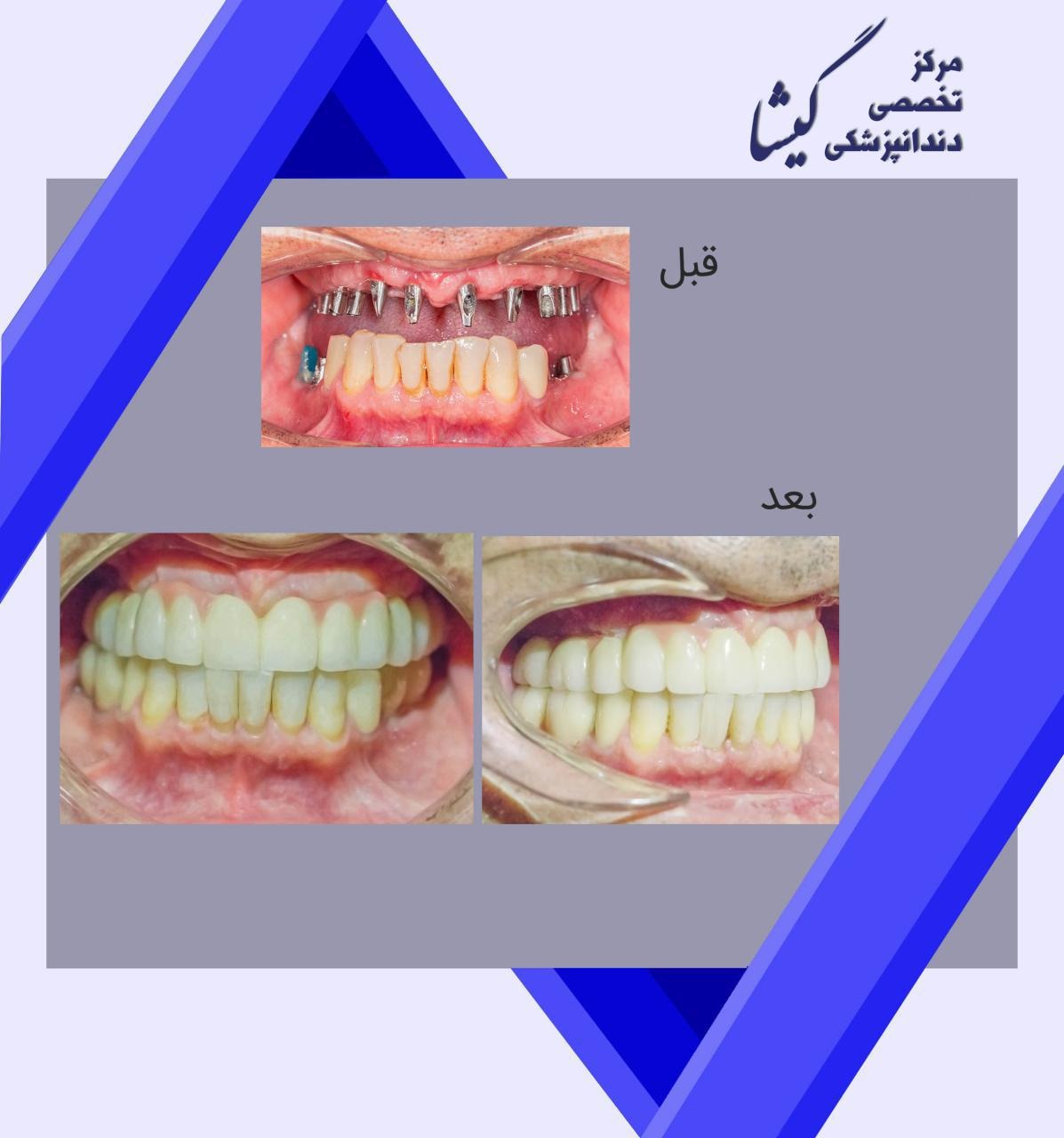 بازسازی دندانهای فک بالا و پایین با ایمپلنت توسط متخصص ایمپلنت
