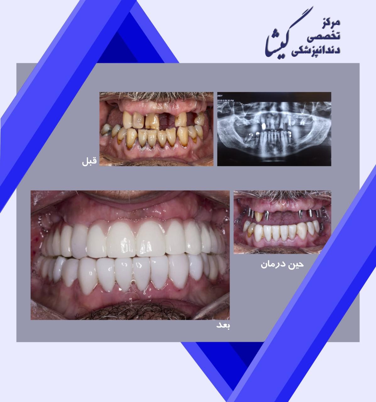 بازسازی کل دندانهای بالا و پایین با ترکیبی از ایمپلنت و روکش تمام سرامیک و کامپوزیت توسط متخصص ایمپلنت و پروتزهای دندانی در تهران