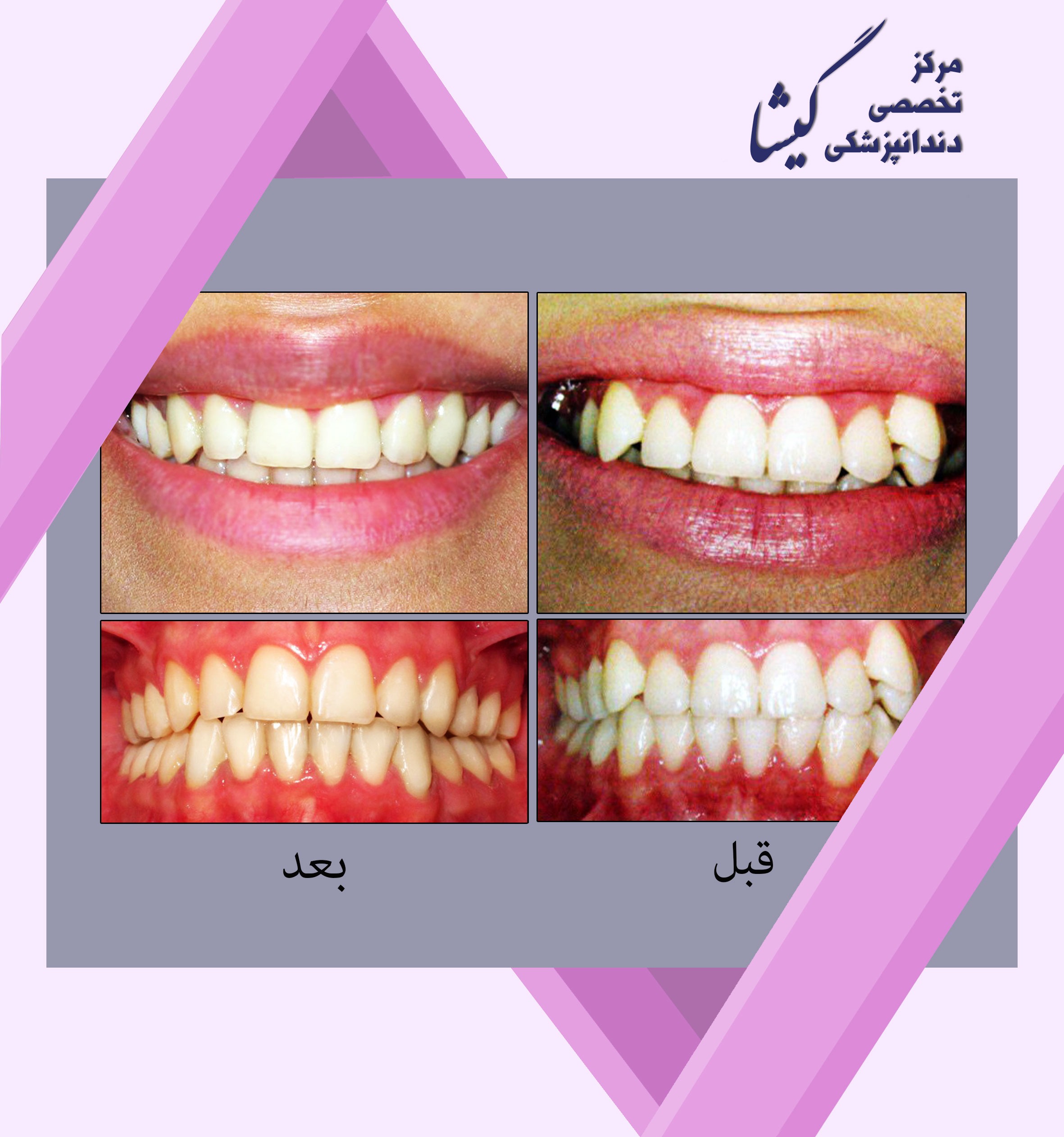 بيمار درمان شده با بيرون زدگي شديد دندانهاي نيش و دستيابي به جفت شدن (اكلوژن ) ايده آل دندانها و لبخندي جذاب!