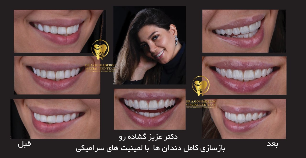 روکش 2