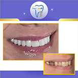 بازسازی لبخند با ترکیبی از درمانهای ایمپلنت دندان و لمینت سرامیکی و روکش تمام سرامیک توسط متخصص ایمپلنت دندان و زیبایی در تهران