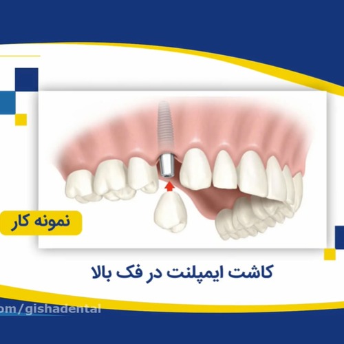 کاشت ایمپلنت در فک بالا