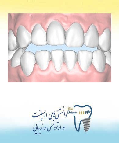 مشکلات ارتودنسی: با انواع اوپن بایت آشنا شوید