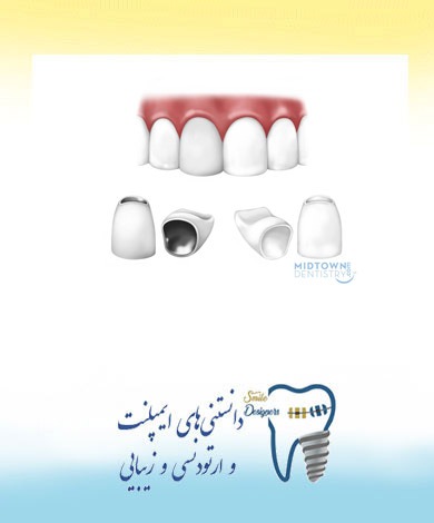 کاربردهای روکش دندان در دندانپزشکی