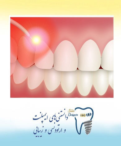 استفاده از لیزر در جراحی ایمپلنت (کاشت دندان)