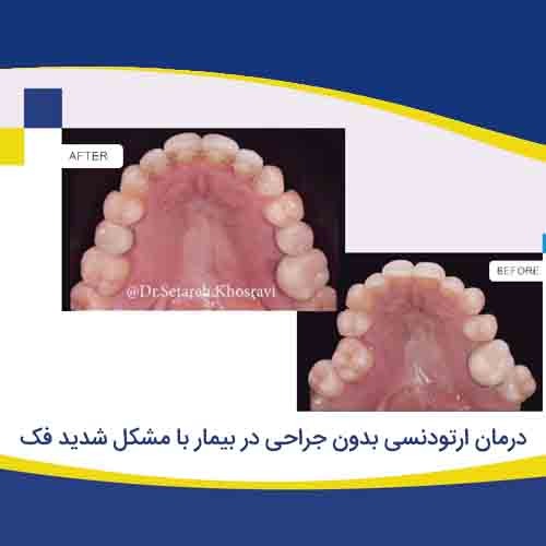 درمان ارتودنسی بدون جراحی با مشکل شدید فک