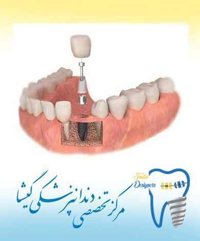 مزایای ایمپلنت دندانی