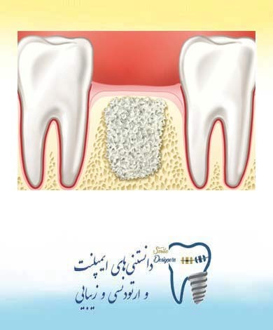 محافظت از ستیغ استخوان فک پس از کشیدن دندان