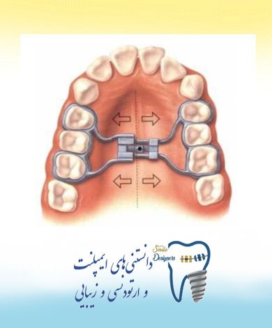 چگونه بزرگ کننده کام فوری فعال می‌شود؟