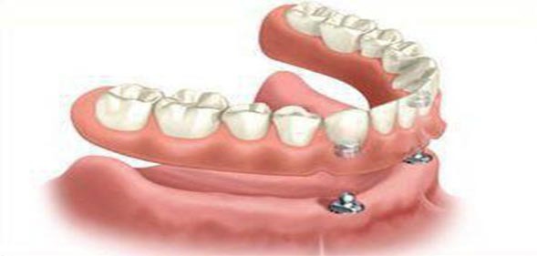 دندان مصنوعی توسط متخصص پروتز دندان و ایمپلنت در غرب تهران