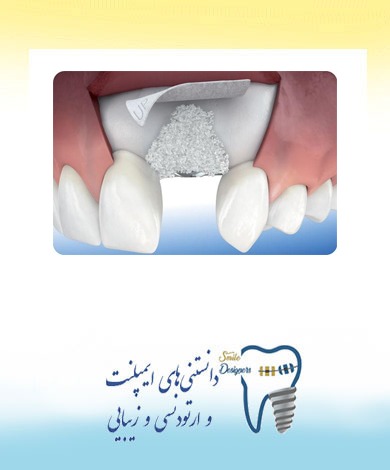 بزرگ کردن ستیغ فک پیش از کاشت ایمپلنت دندان