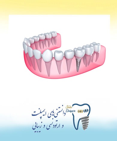 متخصص  ایمپلنت در تهران با مشاوره تخصصی رایگان