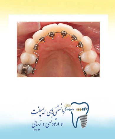 براکت پشت دندانی معایب و مزایای براکت پشت دندانی یا لینگوال