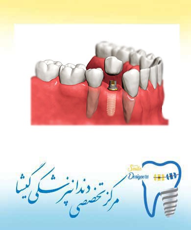 بارگذاری فوری  ایمپلنت دندان توسط متخصص ایمپلنت تهران