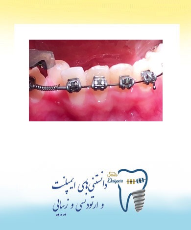 معایب و مزایای ارتودنسی ثابت