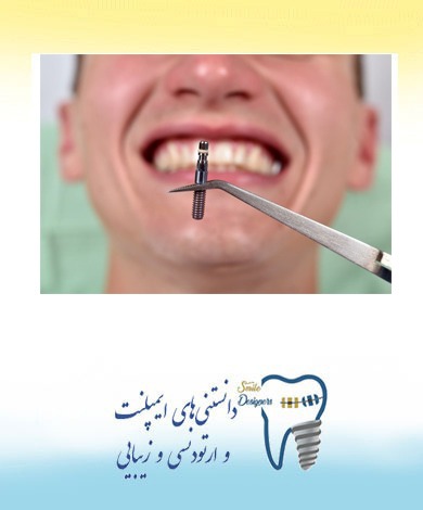 کاربردهای مینی ایمپلنت دندان