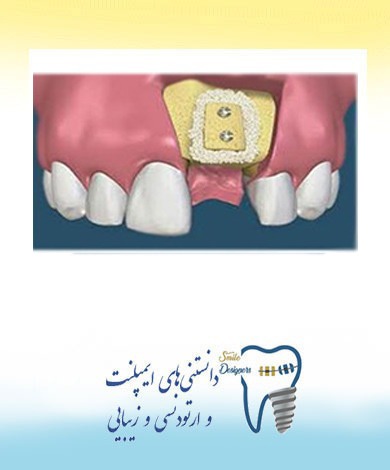 مواد پیوند استخوان برای ایمپلنت دندان