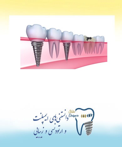 نکاتی که پیش از کاشت ایمپلنت  دندان باید در نظر بگیرید.