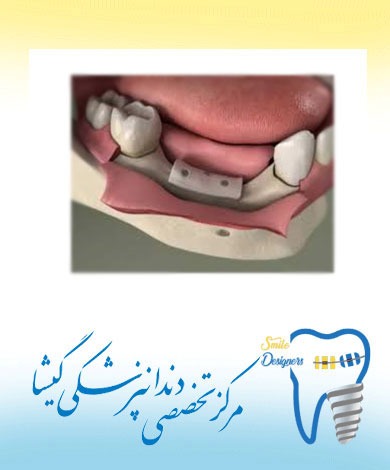 پیوند استخوان برای کاشت ایمپلنت دندان توسط متخصص ایمپلنت در تهران