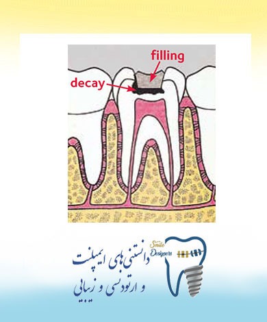 در چه شرایطی دندان پس از پر کردن نیاز به عصب کشی پیدا میکند؟