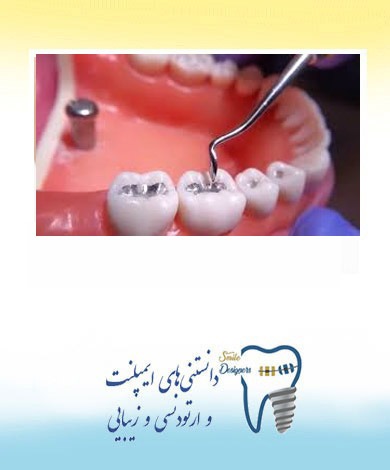 مقایسه آمالگام و کامپوزیت برای ترمیم دندان