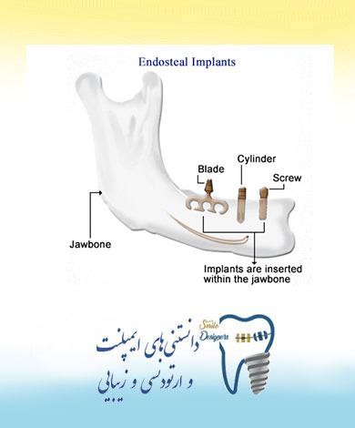 افزایش محبوبیت مینی ایمپلنت دندان