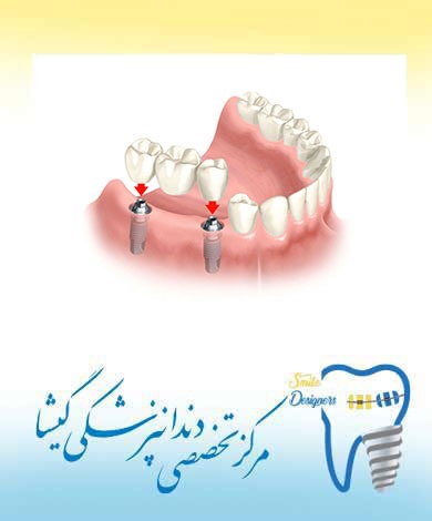 پروتز ثابت متکی بر ایمپلنت های دندانی  توسط متخصص ایمپلنت در تهران