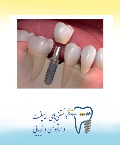 زمان بندی درمان  ایمپلنت (کاشت دندان )