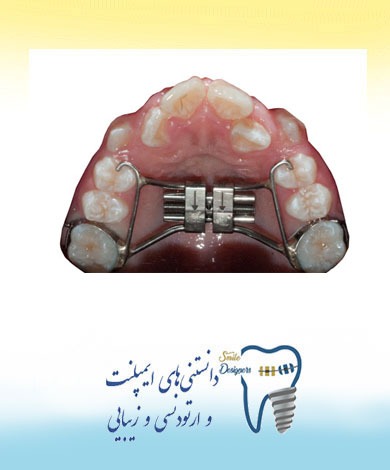 بزرگ کننده فک چیست؟