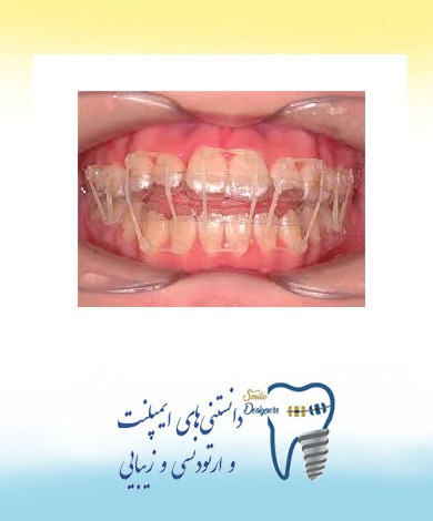 درمان اوپن بایت با الاینر شفاف و الاستیک