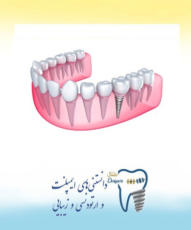 پیش از کاشت ایمپلنت چه کارهایی باید انجام دهیم؟