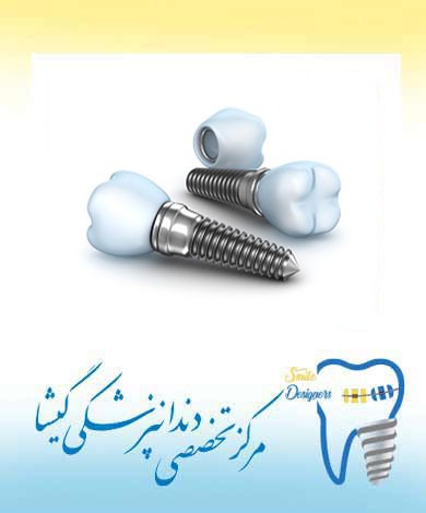 ایمپلنت دندان و روکش یک روزه توسط بهترین متخصص ایمپلنت دندان در شمال  تهران
